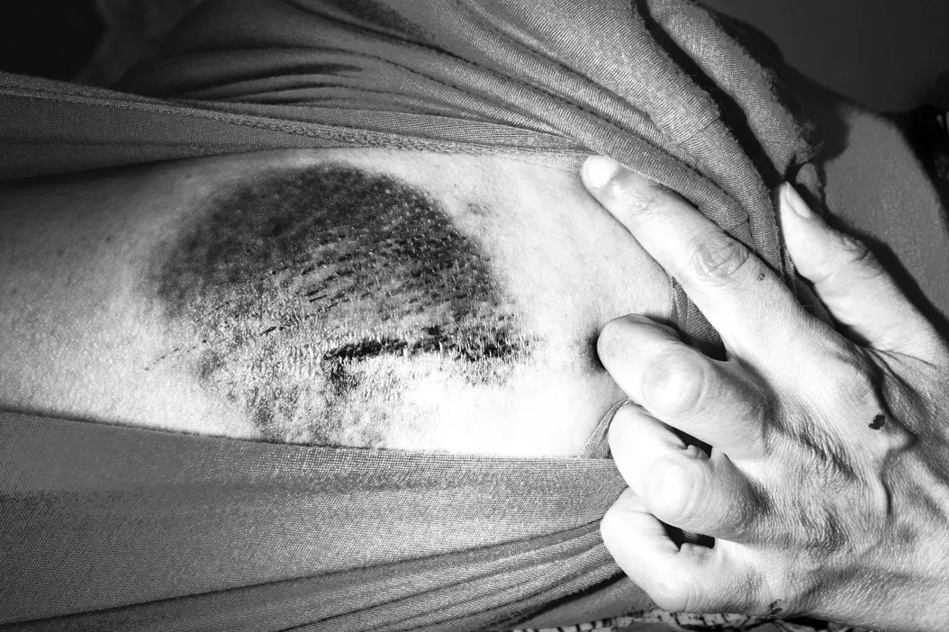 Bone cutter. Skull clamp. Buzz saw.